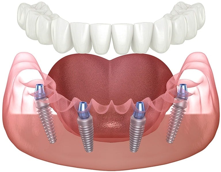 All On 4 Dental Implants