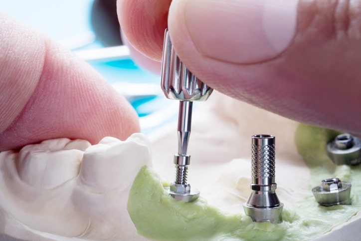 dental implant