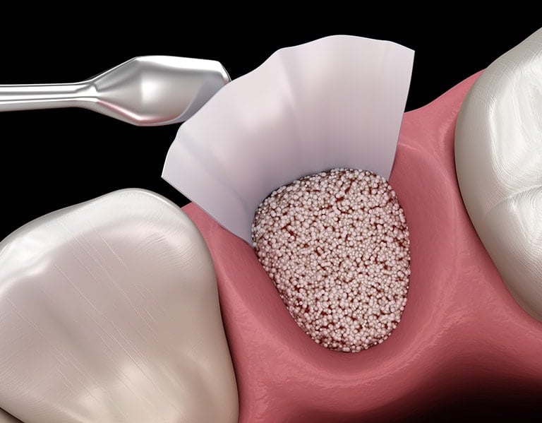 Bone Grafting