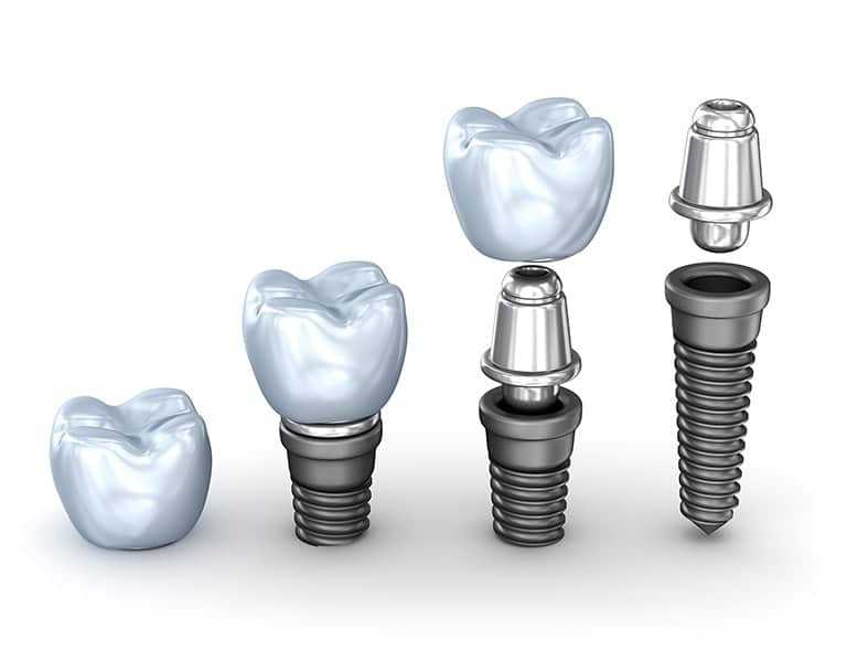 Cost Of Dental Implant In Toronto