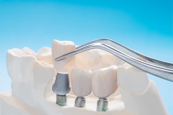 dental implants