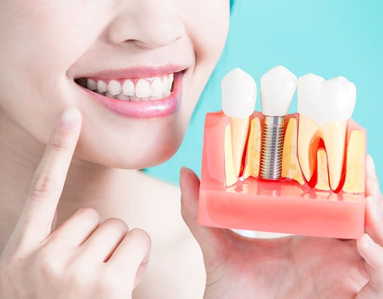 Dental Implants In Toronto