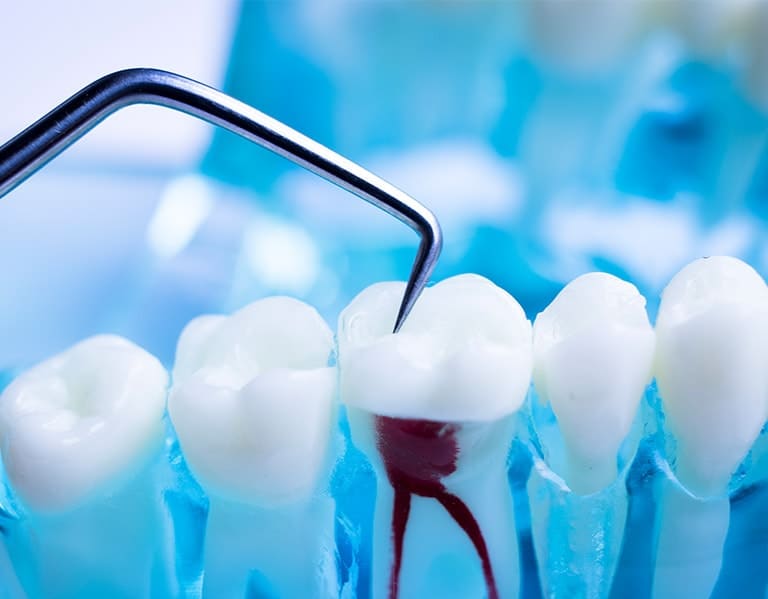 Root Canal Treatment