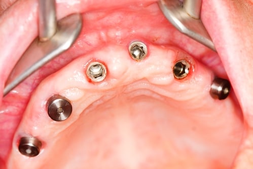 miniature dental implants