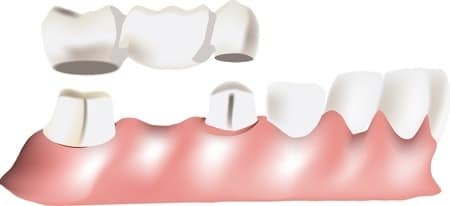 image of dental bridge