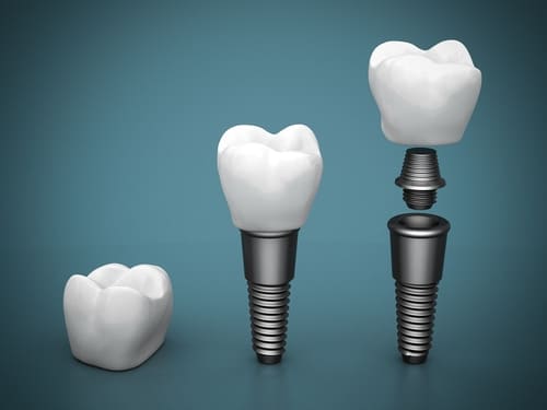 Types Of Dental Implants