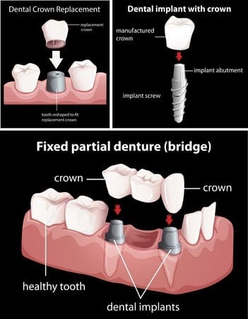 What Are Dental Implants?