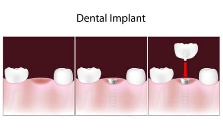 image of how dental implants work