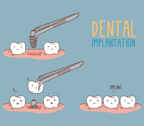 Dental Implants vs Traditional Tooth Replacement Options