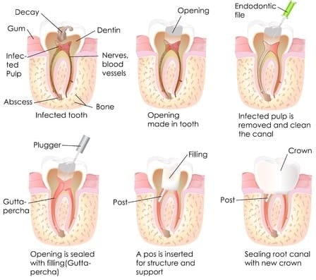 Root Canal Therapy FAQs