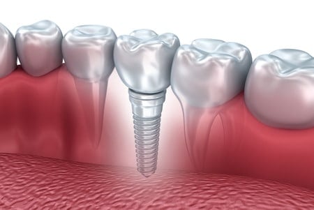 tooth human implant, 3d illustration