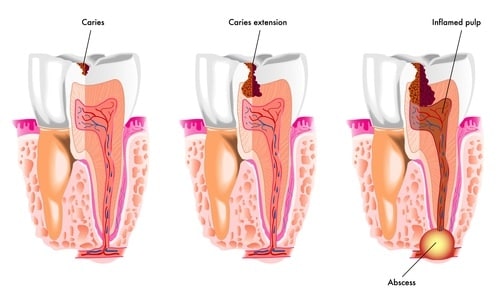 tooth decay process