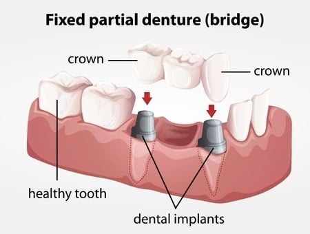 Benefits Of Dental Implants vs Traditional Method