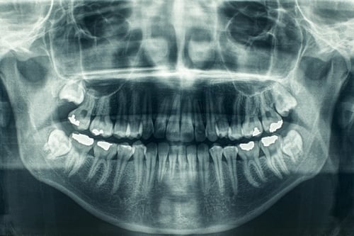 Preliminary Procedures For Dental Implants