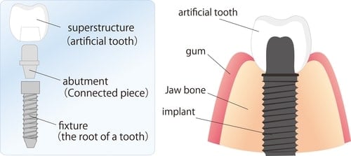 different parts of a dental implant