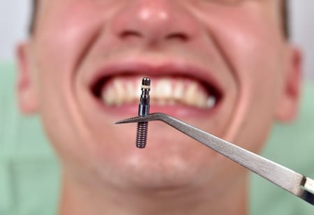dental implant in tweezers on a smile patient background