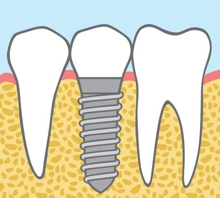 Osseointegration In Dental Implants