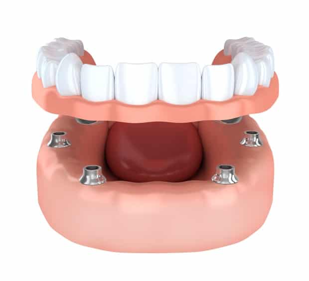 Benefits Of Dental Implant Overdentures