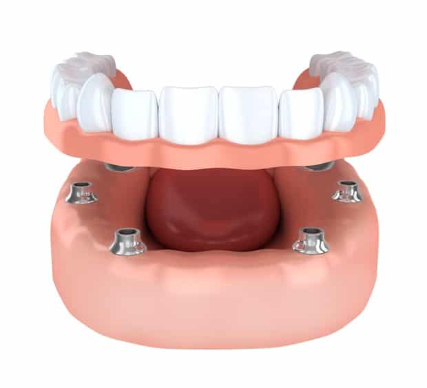 Benefits Of Dental Implant Overdentures