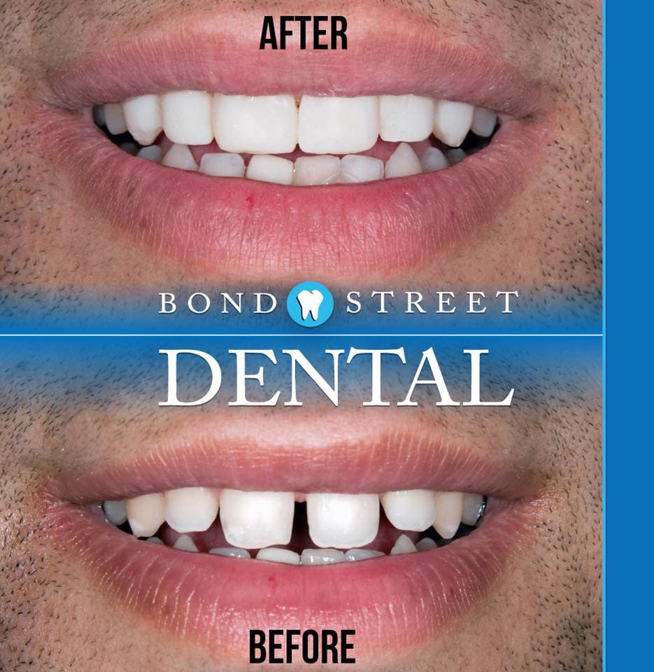 Dental Implants Pictures Before & After Photos of Dental ...