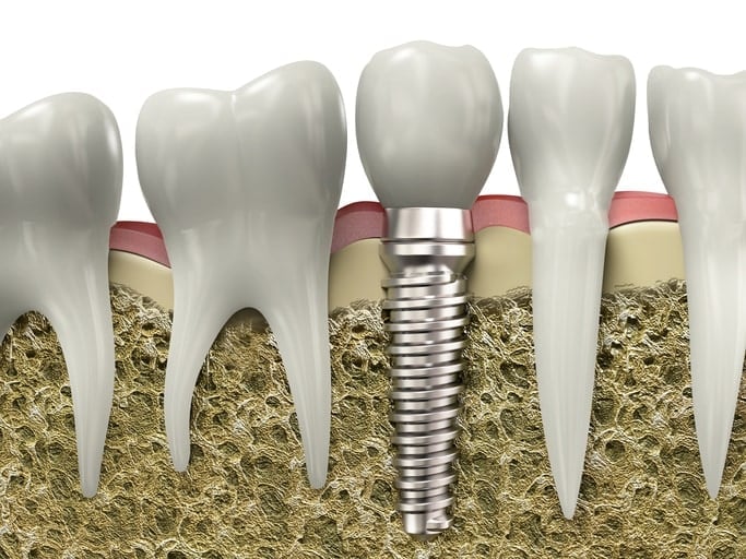 Very high resolution 3d rendering of a dental implant.