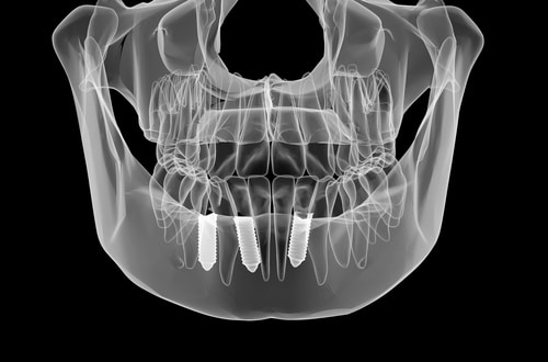 Dental implant and teeth. x-ray view