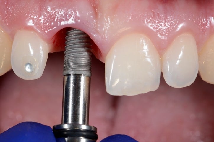 Photo of procedure of dental implantation. Selective focus.