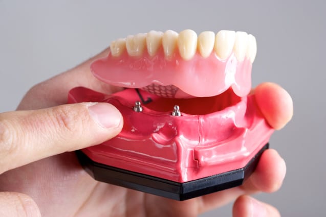 What Are Mini Dental Implants?