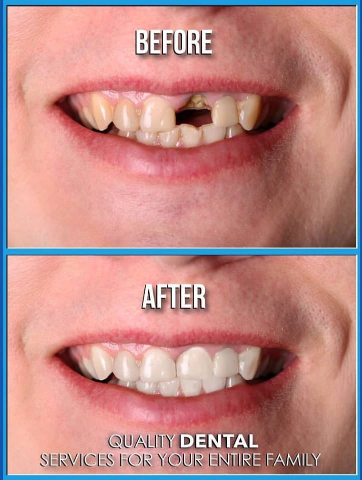 Full Dental Implant Surgery Video at Hal Toone blog