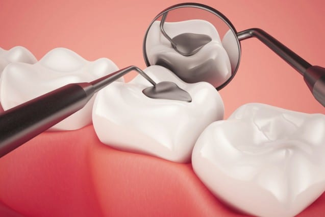 Everything You Need To Know About Cavities