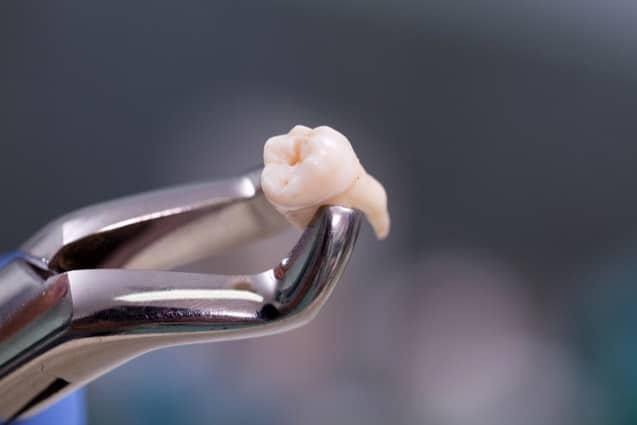 Everything You Need to Know about Tooth Extractions