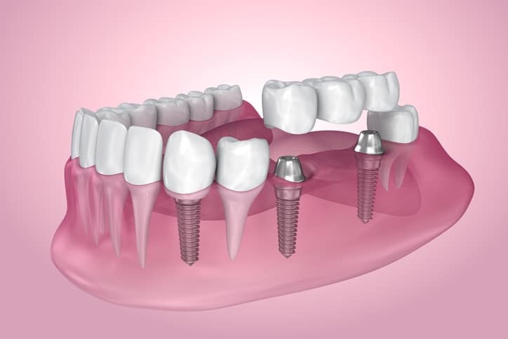 Dental implant process