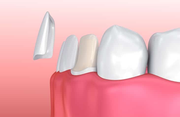 Veneers process