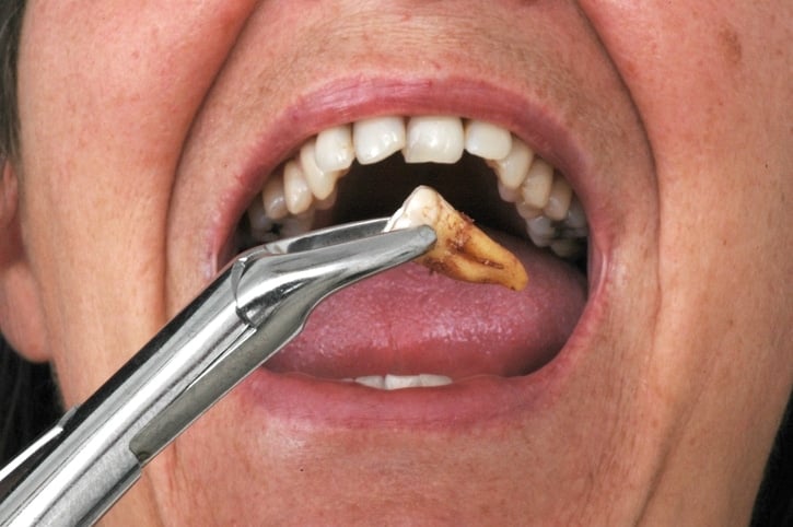 root canal