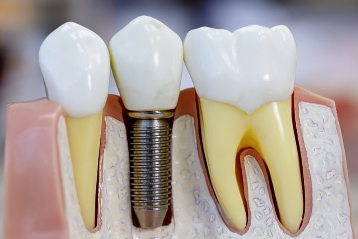 Close up of dental model with implantation