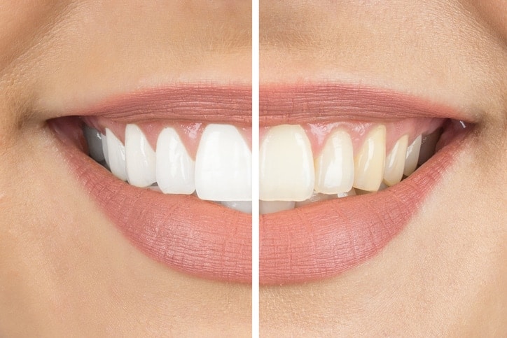 Before and after teeth whitening