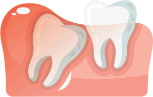 The Ultimate Guide To Wisdom Teeth Upper