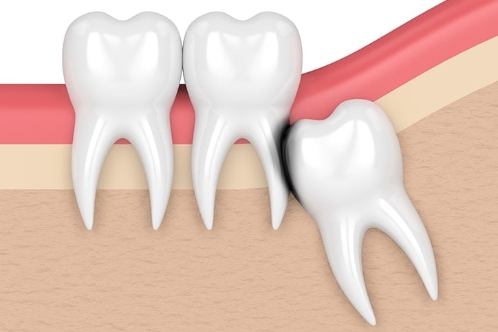 Prevent Adjacent Tooth Damage with Wisdom Teeth Extraction in Toronto