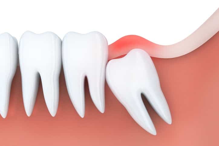 Prevent Infection with Wisdom Teeth Removal