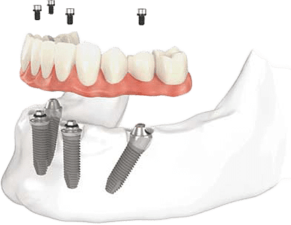 Dental Implants Toronto Starting At 895 Dental Implants Clinic