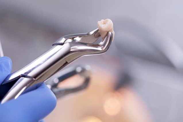 Everything You Need To Know About Wisdom Teeth Removal