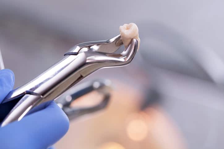 tooth extraction