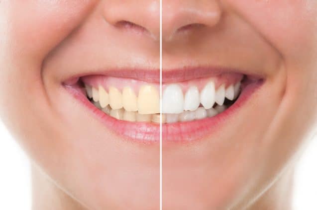 Why You Should Get Your Teeth Whitened By A Professional