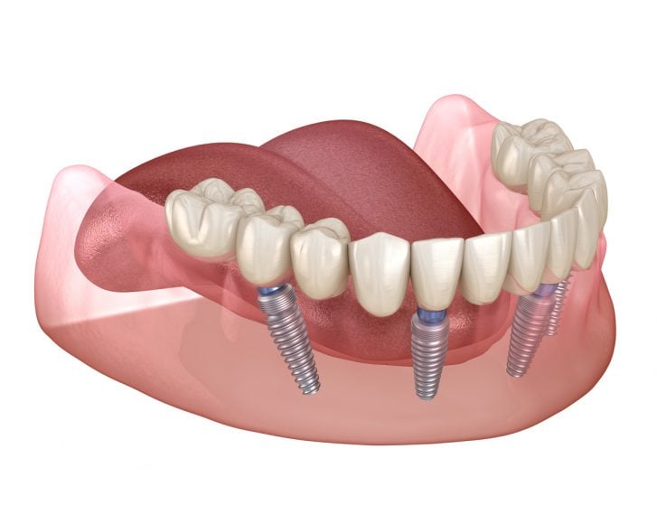 all-on-4 dental implants