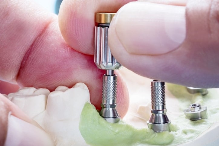 screwing in dental implants