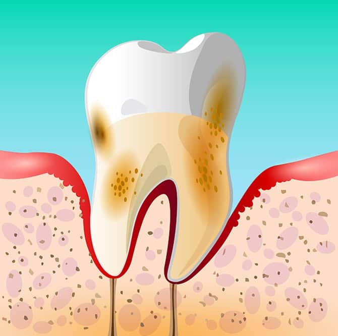 Advanced Periodontal Disease