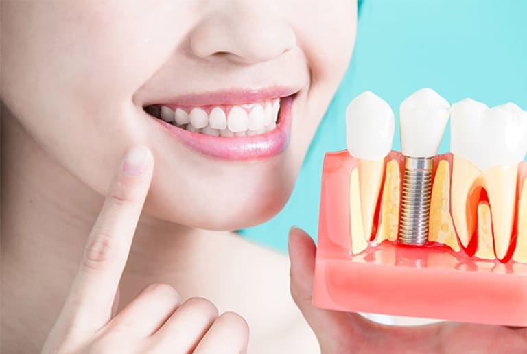 All On 4 Dental Implants Dental Implants