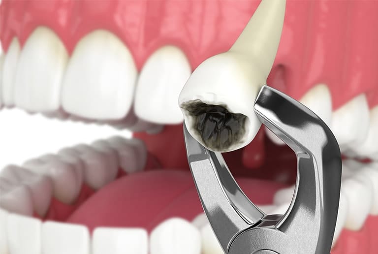 Eliminate Pain Tooth Extraction