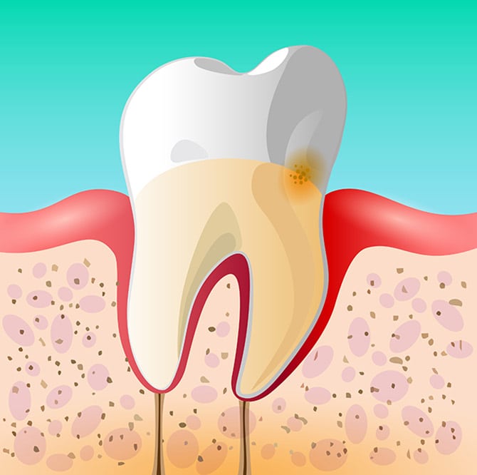 Gingivitis Periodontal Disease