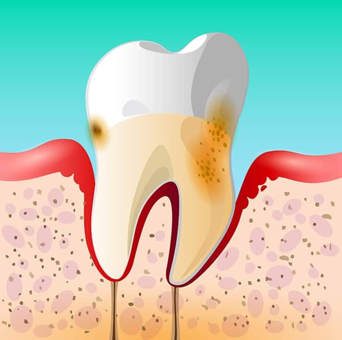 Moderate Periodontal Disease